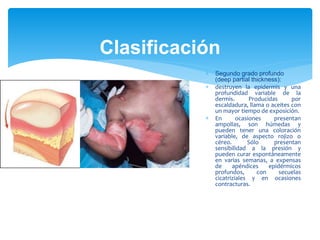 Clasificación
 Segundo grado profundo
(deep partial thickness):
 destruyen la epidermis y una
profundidad variable de la
dermis. Producidas por
escaldadura, llama o aceites con
un mayor tiempo de exposición.
 En ocasiones presentan
ampollas, son húmedas y
pueden tener una coloración
variable, de aspecto rojizo o
céreo. Sólo presentan
sensibilidad a la presión y
pueden curar espontáneamente
en varias semanas, a expensas
de apéndices epidérmicos
profundos, con secuelas
cicatriziales y en ocasiones
contracturas.
 