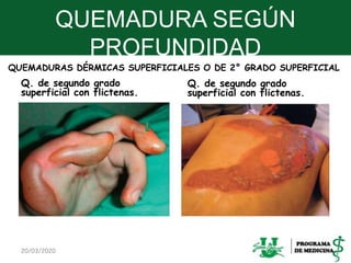 QUEMADURA SEGÚN
PROFUNDIDAD
Q. de segundo grado
superficial con flictenas.
Q. de segundo grado
superficial con flictenas.
20/03/2020 10
QUEMADURAS DÉRMICAS SUPERFICIALES O DE 2° GRADO SUPERFICIAL
 