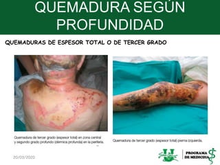 QUEMADURA SEGÚN
PROFUNDIDAD
20/03/2020 16
QUEMADURAS DE ESPESOR TOTAL O DE TERCER GRADO
 