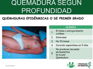 QUEMADURA SEGÚN
PROFUNDIDAD
CLINICA
1
Eritema o enrojecimiento
cutáneo
2 Dolorosas
3 No flictenas
4 Curación espontánea en 5 días
5
No producen secuelas
permanentes
en la piel
Quemadura
20/03/2020 8
QUEMADURAS EPIDÉRMICAS O DE PRIMER GRADO
 