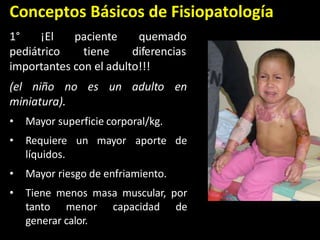 Conceptos Básicos de Fisiopatología
1° ¡El
pediátrico
paciente
tiene
quemado
diferencias
importantes con el adulto!!!
(el niño no es un adulto en
miniatura).
• Mayor superficie corporal/kg.
• Requiere un mayor aporte de
líquidos.
• Mayor riesgo de enfriamiento.
• Tiene menos masa muscular, por
tanto menor capacidad de
generar calor.
 