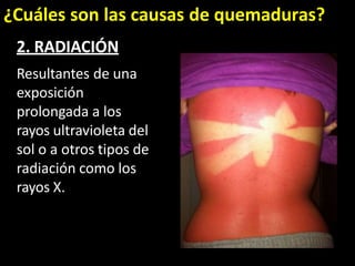 ¿Cuáles son las causas de quemaduras?
2. RADIACIÓN
Resultantes de una
exposición
prolongada a los
rayos ultravioleta del
sol o a otros tipos de
radiación como los
rayos X.
 