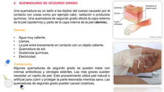 2. QUEMADURAS DE SEGUNDO GRADO:
Una quemadura es un daño a los tejidos del cuerpo causado por el
contacto con cosas como por ejemplo calor, radiación o productos
químicos. Una quemadura de segundo grado afecta la capa externa
de la piel (epidermis) y parte de la capa interna de la piel (dermis).
Causas:
• Agua muy caliente.
• Llamas.
• La piel entra brevemente en contacto con un objeto caliente.
• Quemadura de sol.
• Sustancias químicas.
• Electricidad.
Tratamiento
Algunas quemaduras de segundo grado se pueden tratar con
cremas antibióticas y vendajes estériles. Las más graves pueden
necesitar un injerto de piel. Este procedimiento utiliza piel natural o
artificial para cubrir y proteger la parte lesionada mientras sana. Las
quemaduras de segundo grado pueden causar cicatrices.
 