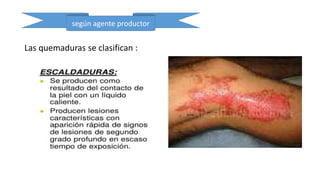 Las quemaduras se clasifican :
según agente productor
 
