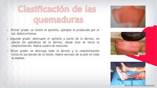 ▶ Primer grado: se limita al epitelio, ejemplo la producida por el
sol, habrá eritema.
▶ Segundo grado: destruyen el epitelio y parte de la dermis, no
afecta los apéndices de la dermis, desde ésta se inicia la
reepitelización. Habrá cuadro de vesículas.
▶ Tercer grado: se destruye toda la dermis y la reepitelización
inicia en los bordes de la lesión. Habrá necrosis de la piel en todo
su espesor.
 
