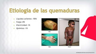 ▶ Líquidos calientes : 90%
▶ Fuego: 8%
▶ Electricidad: 1%
▶ Químicas: 1%
 