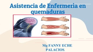 Asistencia de Enfermerìa en
quemaduras
Mg FANNY ECHE
PALACIOS.
 