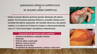 QUEMADURAS DÉRMICAS SUPERFICIALES
O
DE SEGUNDO GRADO SUPERFICIAL
• Dañan el estrato dérmico de forma parcial, afectando sólo dermis
papilar. Con frecuencia aparecen flictenas o ampollas intactas como
resultado del edema subyacente. Son también dolorosas y de aspecto
rosáceo y si se retiran las fl ictenas la imagen es clásicamente descrita
como un “rocío hemorrágico” (exudativas e hiperémicas).
Quemaduras de segundo grado superficial
• Presencia de flictena o ampollas intactas
• Dolorosas
• Folículo piloso conservado
• Retorno venoso normal
• Remisión en 8-10 días
• Posibilidad de despigmentación cutánea o discromía
 