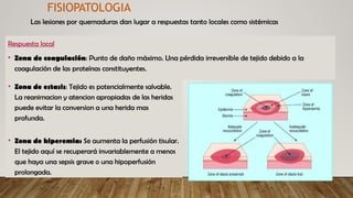 FISIOPATOLOGIA
Respuesta local
• Zona de coagulación: Punto de daño máximo. Una pérdida irreversible de tejido debido a la
coagulación de las proteínas constituyentes.
Las lesiones por quemaduras dan lugar a respuestas tanto locales como sistémicas
• Zona de estasis: Tejido es potencialmente salvable.
La reanimacion y atencion apropiadas de las heridas
puede evitar la conversion a una herida mas
profunda.
• Zona de hiperemia: Se aumenta la perfusión tisular.
El tejido aquí se recuperará invariablemente a menos
que haya una sepsis grave o una hipoperfusión
prolongada.
 