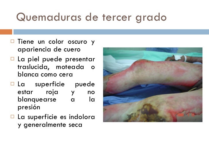 quemaduras cuarto grado - 28 images - quemaduras de cuarto grado 28 ... quemaduras cuarto grado - 28 images - quemaduras de cuarto grado 28 ...