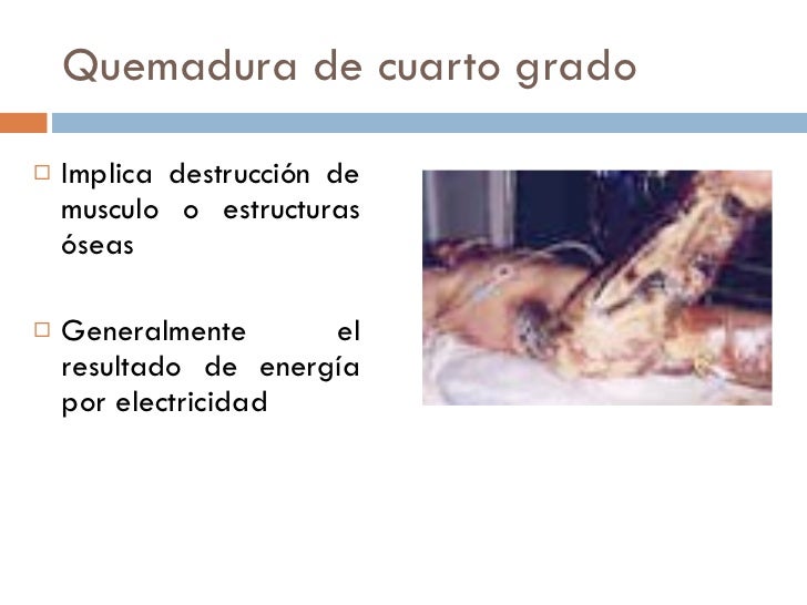 Quemaduras. Quemaduras.