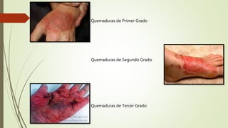 Quemaduras de Primer Grado
Quemaduras de Segundo Grado
Quemaduras de Tercer Grado
 