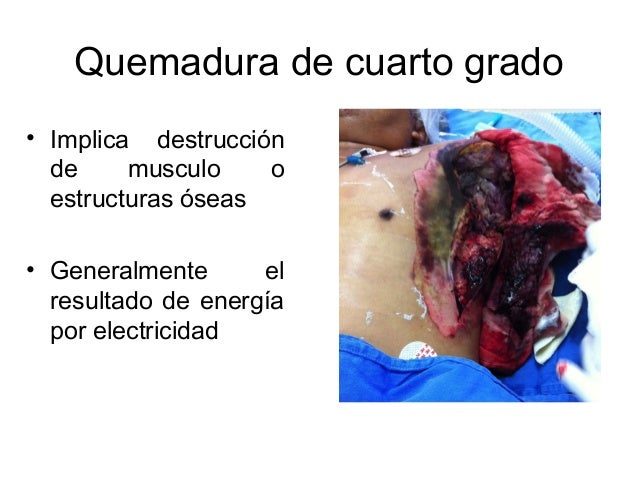 Quemaduras y Sustancias Peligrosas Quemaduras y Sustancias Peligrosas