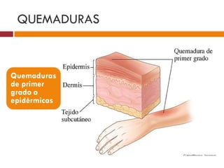 QUEMADURAS 