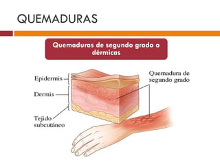 QUEMADURAS 
