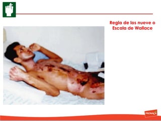 Regla de los nueve o
Escala de Wallace

 