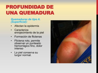 PROFUNDIDAD DE
UNA QUEMADURA
 Quemaduras de tipo A.
 (Superficial):
 • Afectan la epidermis
 • Caracteriza
    enrojecimiento de la piel
 • Formación de flictenas
 • Flictena roto, permite
    observar un punteado
    hemorrágico fino, dolor
    intenso
 • La piel conserva su
    turgor normal.
 