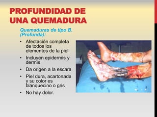 PROFUNDIDAD DE
UNA QUEMADURA
 Quemaduras de tipo B.
 (Profunda):
 • Afectación completa
    de todos los
    elementos de la piel
 • Incluyen epidermis y
    dermis
 • Da origen a la escara
 • Piel dura, acartonada
    y su color es
    blanquecino o gris
 • No hay dolor.
 