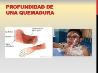 PROFUNDIDAD DE
UNA QUEMADURA
 