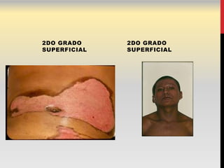 2DO GRADO     2DO GRADO
SUPERFICIAL   SUPERFICIAL
 