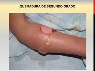 QUEMADURA DE SEGUNDO GRADO
 