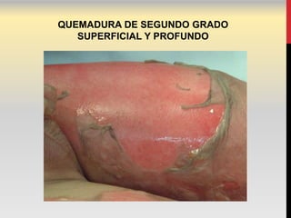 QUEMADURA DE SEGUNDO GRADO
   SUPERFICIAL Y PROFUNDO
 