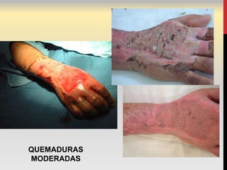 QUEMADURAS
MODERADAS
 