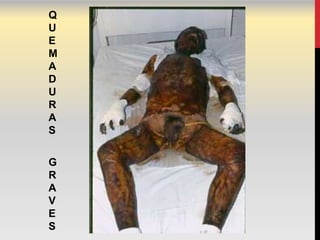 Q
U
E
M
A
D
U
R
A
S


G
R
A
V
E
S
 