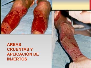 AREAS
CRUENTAS Y
APLICACIÓN DE
INJERTOS
 