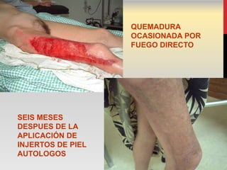 QUEMADURA
                   OCASIONADA POR
                   FUEGO DIRECTO




SEIS MESES
DESPUES DE LA
APLICACIÓN DE
INJERTOS DE PIEL
AUTOLOGOS
 