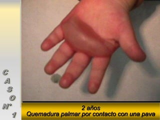 C
A
 S
  O
N°                      2 años
   1   Quemadura palmar por contacto con una pava
 