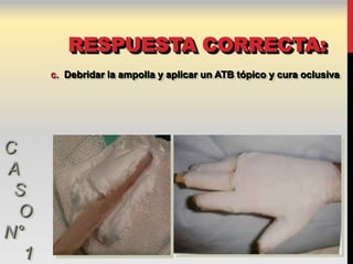 RESPUESTA CORRECTA:
      c. Debridar la ampolla y aplicar un ATB tópico y cura oclusiva




C
A
 S
  O
N°
  1
 