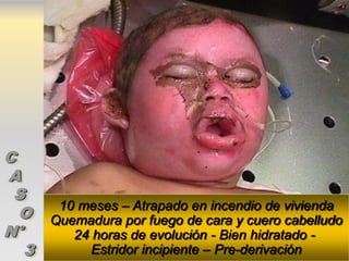 C
A
 S
        10 meses – Atrapado en incendio de vivienda
  O    Quemadura por fuego de cara y cuero cabelludo
N°        24 horas de evolución - Bien hidratado -
   3         Estridor incipiente – Pre-derivación
 