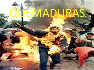 QUEMADURAS
1
 