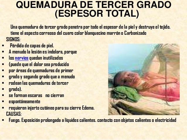 Quemaduras, clasificación y cuidados de enfermería
