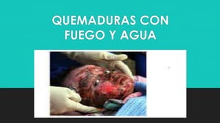 QUEMADURAS CON
FUEGO Y AGUA
 