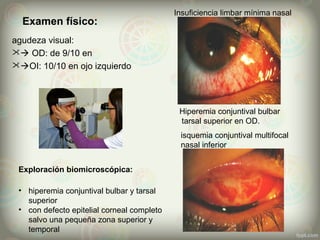 agudeza visual:
 OD: de 9/10 en
OI: 10/10 en ojo izquierdo
Insuficiencia limbar mínima nasal
Hiperemia conjuntival bulbar
tarsal superior en OD.
Exploración biomicroscópica:
isquemia conjuntival multifocal
nasal inferior
• hiperemia conjuntival bulbar y tarsal
superior
• con defecto epitelial corneal completo
salvo una pequeña zona superior y
temporal
Examen físico:
 