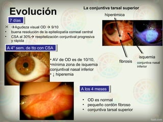 Evolución
 Agudeza visual OD  9/10
• buena resolución de la epiteliopatía corneal central
• CSA al 30% reepitelización conjuntival progresiva
y rápida
fibrosis
hiperémica
La conjuntiva tarsal superior
isquemia
conjuntiva nasal
inferior
• AV de OD es de 10/10,
•mínima zona de isquemia
conjuntival nasal inferior
• ↓ hiperemia
A 4° sem. de tto con CSAA 4° sem. de tto con CSA
• OD es normal
• pequeño cordón fibroso
• conjuntiva tarsal superior
A los 4 mesesA los 4 meses
7 días7 días
 