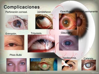 Complicaciones
Catarata
Perforación corneal. (simbléfaron Opacificación corneal permanente
Entropión. Triquiasis. Glaucoma
Ptisis Bulbi
hipolacrimia.
 
