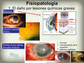 Fisiopatología
1. El daño por lesiones químicas graves:
NecrosisNecrosis
oclusión y vascularización
límbica.
oclusión y vascularización
límbica.
• Corneal:
 vascularización de la
superficie
 defectos epiteliales
Pérdida de las células
troncales límbicas
Pérdida de las células
troncales límbicas
 
