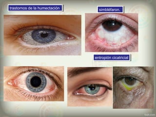 simbléfaron.simbléfaron.trastornos de la humectacióntrastornos de la humectación
entropión cicatricialentropión cicatricial
 