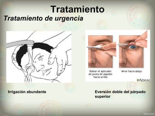 Tratamiento
 Tratamiento de urgencia
Irrigación abundante Eversión doble del párpado
superior
 