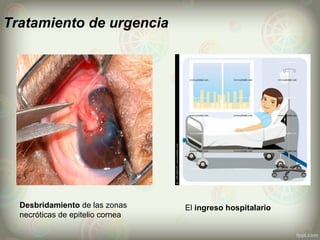 Tratamiento de urgencia
Desbridamiento de las zonas
necróticas de epitelio cornea
El ingreso hospitalario
 