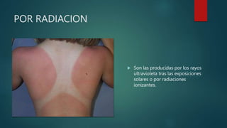 POR RADIACION
 Son las producidas por los rayos
ultravioleta tras las exposiciones
solares o por radiaciones
ionizantes.
 