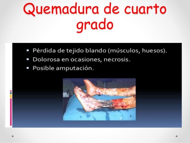 Quemaduras Quemaduras