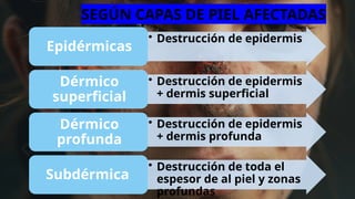 • Destrucción de epidermis
Epidérmicas
• Destrucción de epidermis
+ dermis superficial
Dérmico
superficial
• Destrucción de epidermis
+ dermis profunda
Dérmico
profunda
• Destrucción de toda el
espesor de al piel y zonas
profundas
Subdérmica
SEGÚN CAPAS DE PIEL AFECTADAS
 