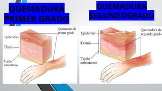QUEMADURA
PRIMER GRADO
QUEMADURA
SEGUNDOGRADO
 
