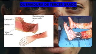 QUEMADURA DE TERCER GRADO
 