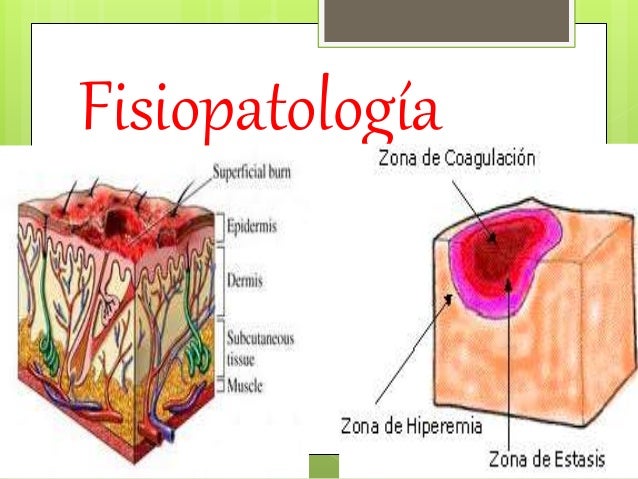 FISIOLOGIA DE LAS QUEMADURAS Enfermeria En Camino Al