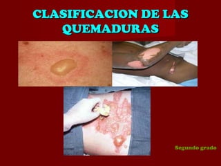 CLASIFICACION DE LASCLASIFICACION DE LAS
QUEMADURASQUEMADURAS
Segundo grado
 